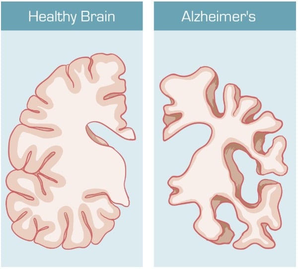 Alzheimer_kor