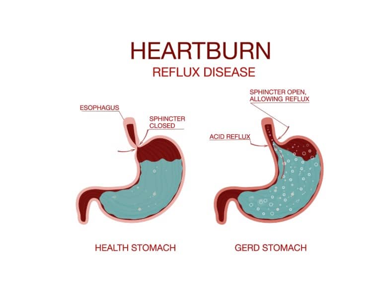Reflux